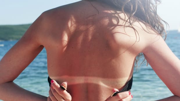 Your Sunburn Relief Has Arrived: Best Natural After Sun Products
