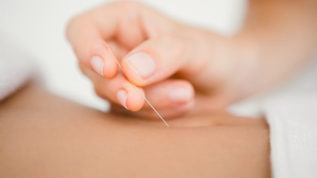 Get to the Point: Treating Infertility with Acupuncture