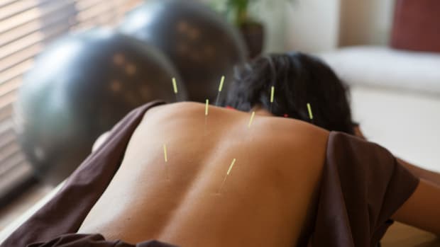 Should You Get Regular Acupuncture for Health Maintenance