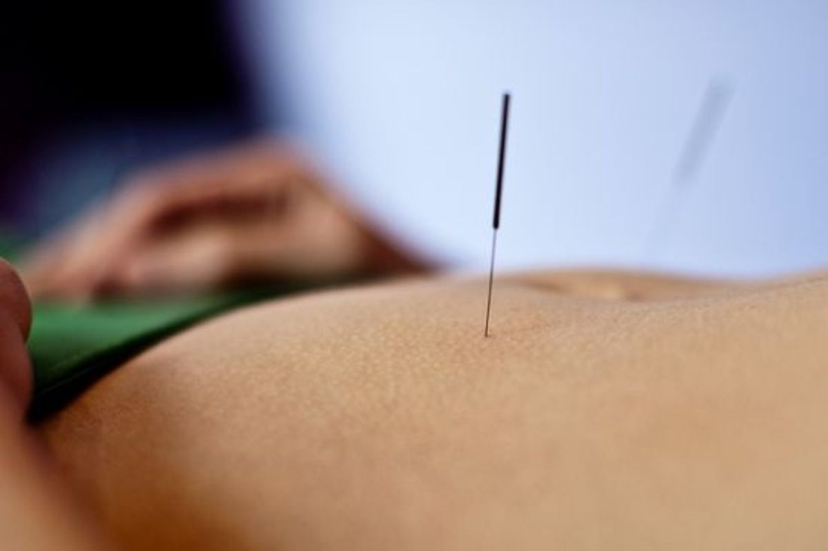 acupuncture-ccflcr-marniejoyce