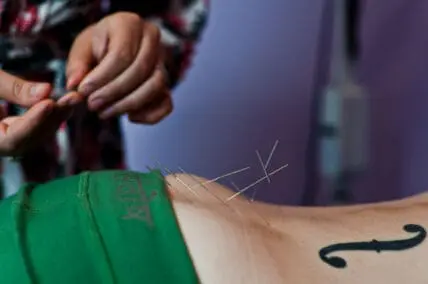 Why the Benefits of Acupuncture For Pain Are Unparalleled