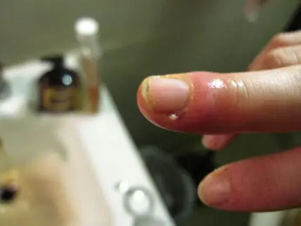 c. diff bacterial infection photo
