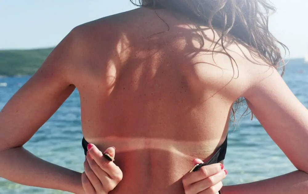 Your Sunburn Relief Has Arrived: Best Natural After Sun Products
