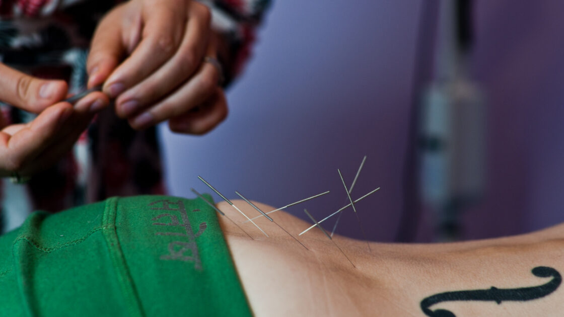 Why the Benefits of Acupuncture For Pain Are Unparalleled