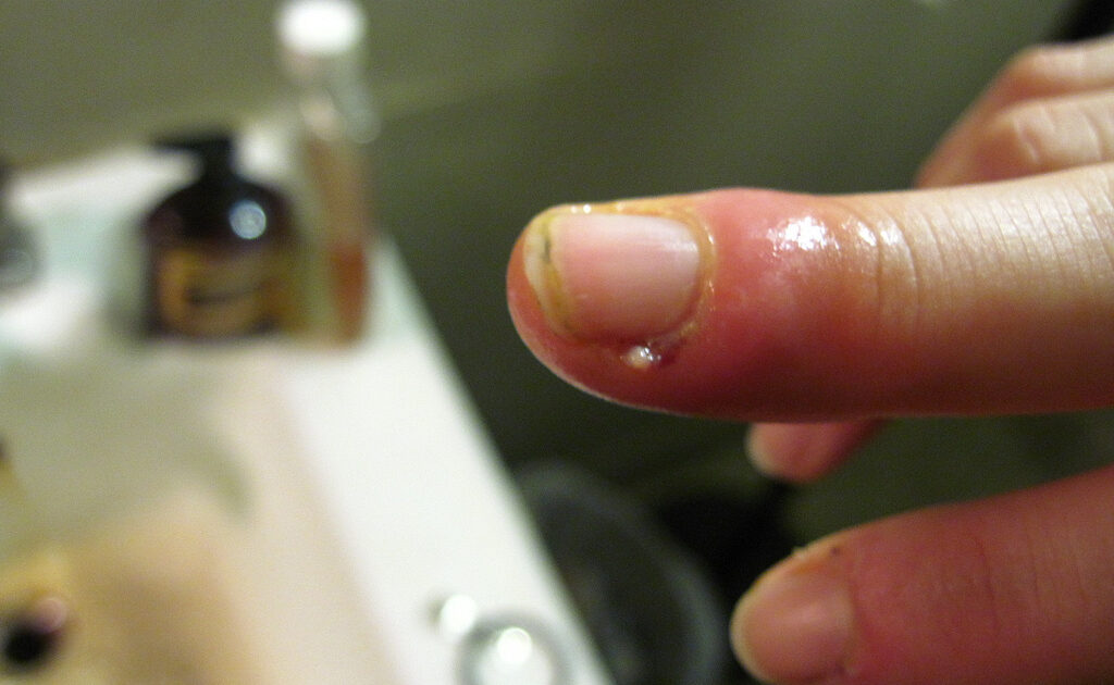 c. diff bacterial infection photo