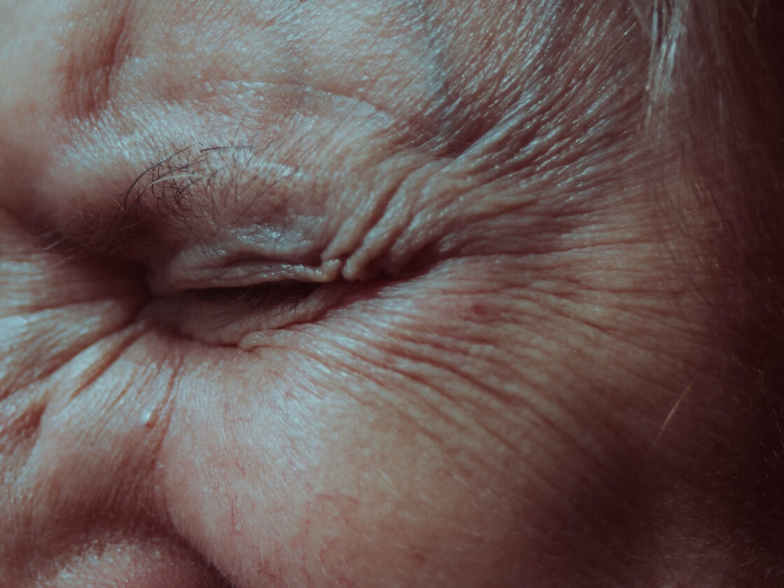 Hydrolyzed marine collagen and collagen supplements and powders may help with wrinkle reduction like crow's feet. Image close up of wrinkles like crow's feet on a person's face. Collagen peptides powders may help with things like skin moisture, healthy bones, but more research needs to be done.