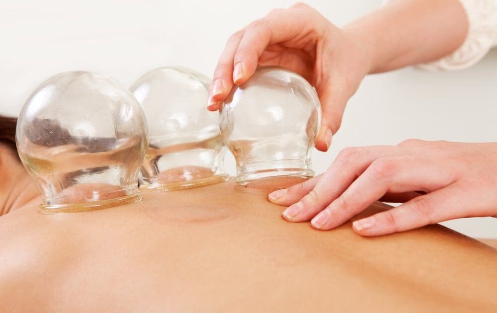 What is Cupping and Why is Michael Phelps a Fan?